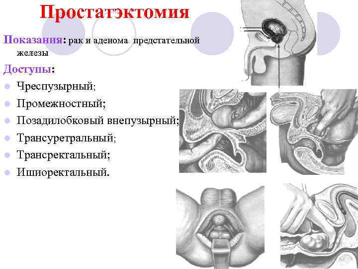 Простатэктомия Показания: рак и аденома предстательной железы Доступы: l Чреспузырный; l Промежностный; l Позадилобковый