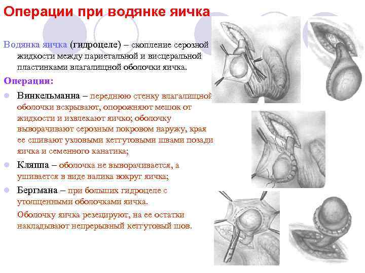 Операции при водянке яичка Водянка яичка (гидроцеле) – скопление серозной жидкости между париетальной и