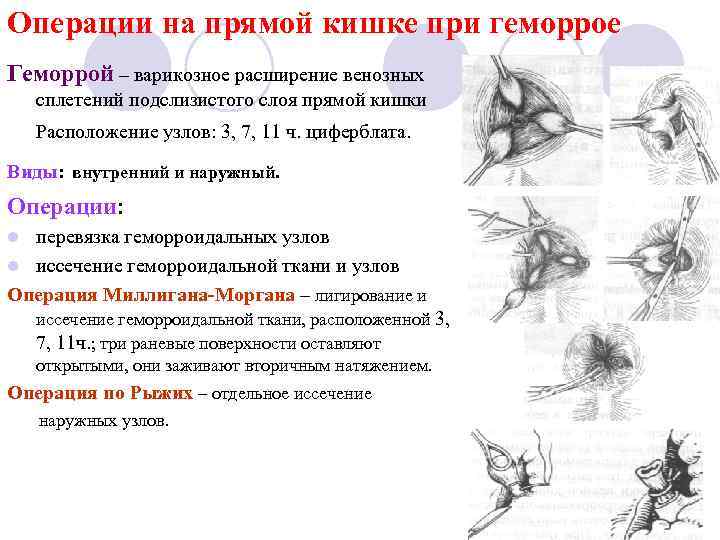 Операции на прямой кишке при геморрое Геморрой – варикозное расширение венозных сплетений подслизистого слоя