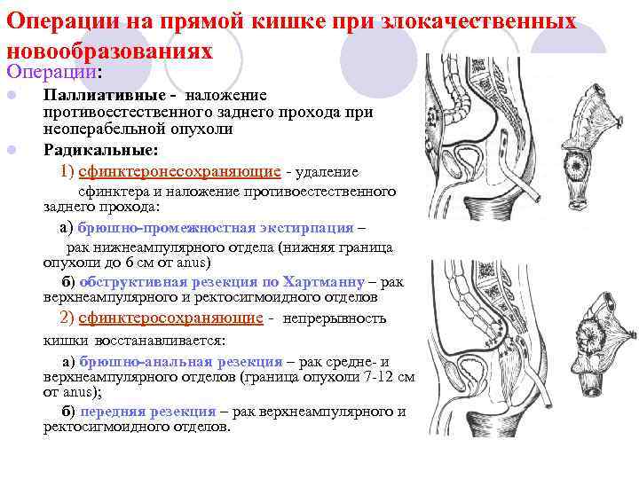 Операции на прямой кишке при злокачественных новообразованиях Операции: l l Паллиативные - наложение противоестественного