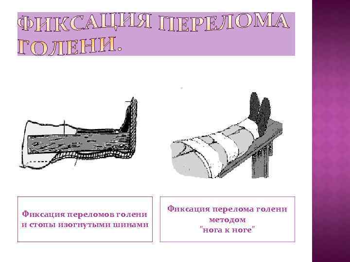 Фиксация переломов голени и стопы изогнутыми шинами Фиксация перелома голени методом "нога к ноге"