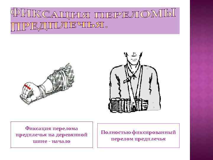 Фиксация перелома предплечья на деревянной шине - начало Полностью фиксированный перелом предплечья 