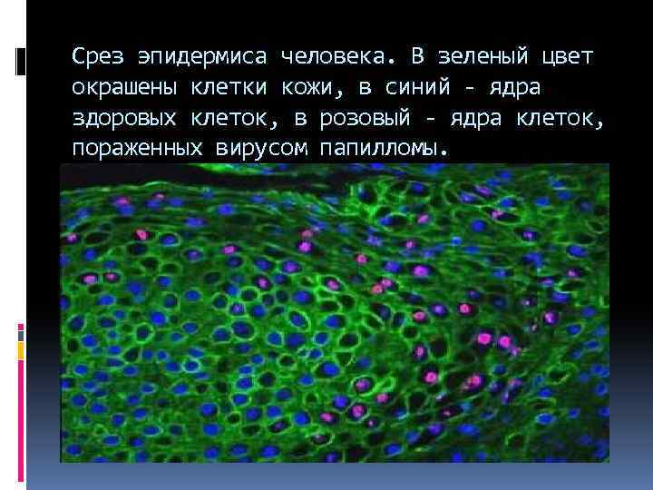 Срез эпидермиса человека. В зеленый цвет окрашены клетки кожи, в синий - ядра здоровых