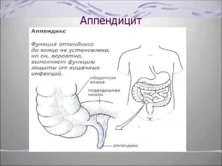 Аппендицит 