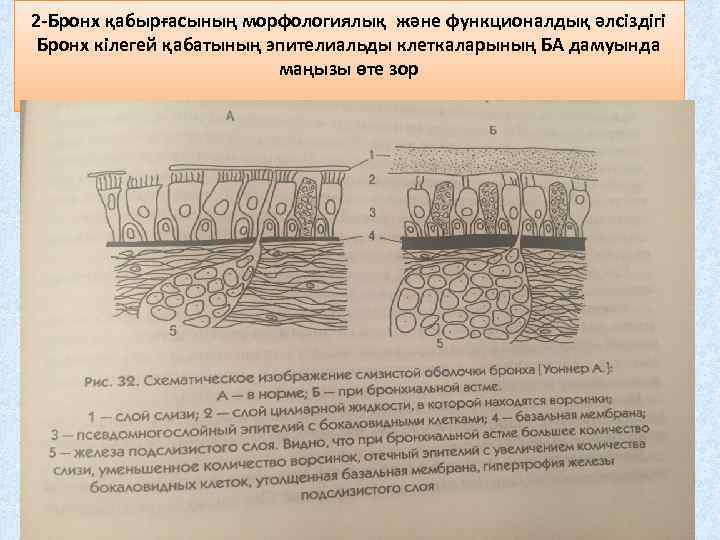 2 -Бронх қабырғасының морфологиялық және функционалдық әлсіздігі Бронх кілегей қабатының эпителиальды клеткаларының БА дамуында