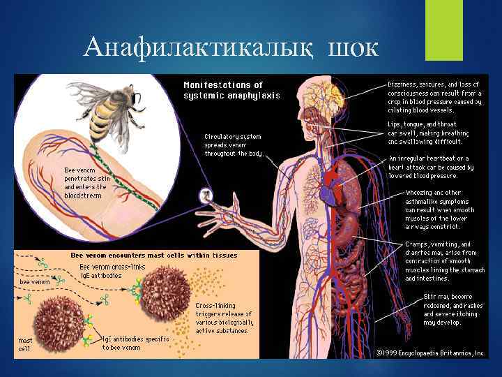  Анафилактикалық шок 