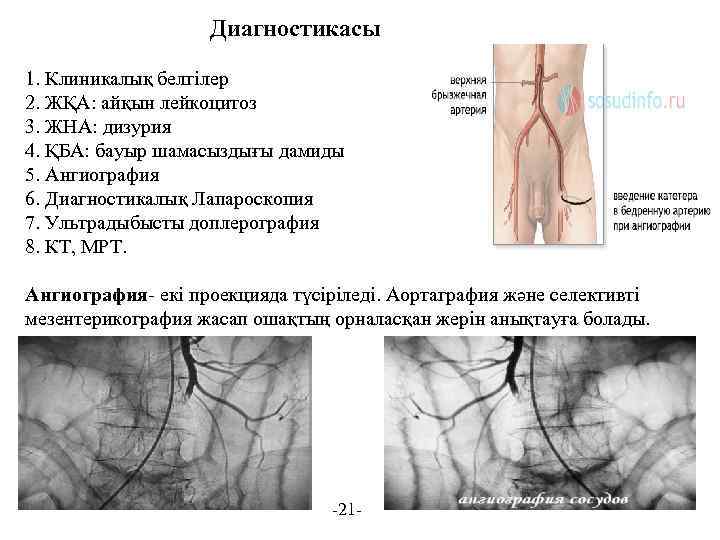 Диагностикасы 1. Клиникалық белгілер 2. ЖҚА: айқын лейкоцитоз 3. ЖНА: дизурия 4. ҚБА: бауыр