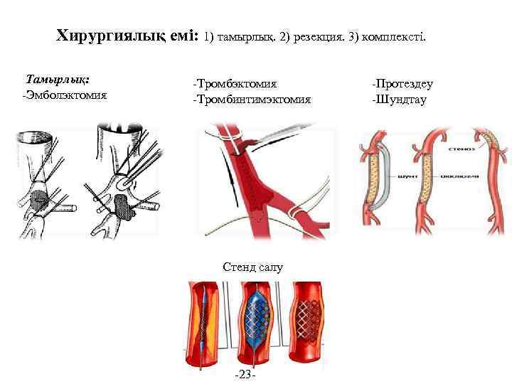 Хирургиялық емі: 1) тамырлық. 2) резекция. 3) комплексті. Тамырлық: -Эмболэктомия -Тромбинтимэктомия Стенд салу -23