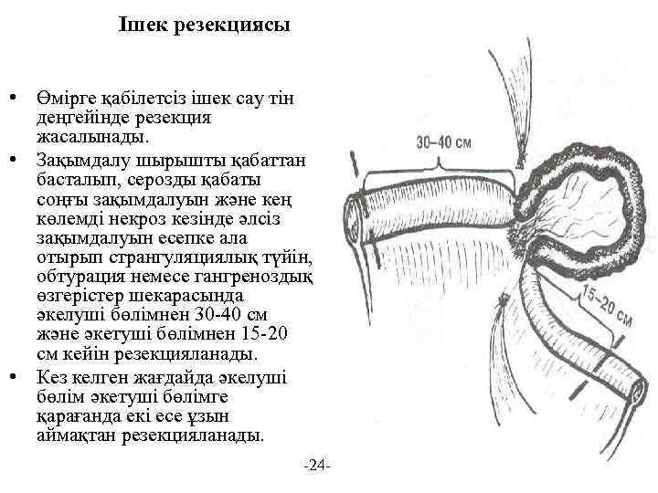Ішек резекциясы • Өмірге қабілетсіз ішек сау тін деңгейінде резекция жасалынады. • Зақымдалу шырышты