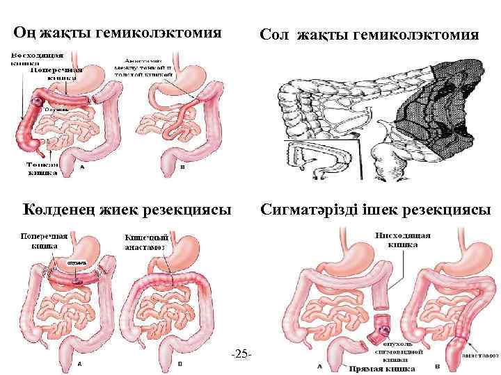 Оң жақты гемиколэктомия Сол жақты гемиколэктомия Көлденең жиек резекциясы -25 - Сигматәрізді ішек резекциясы