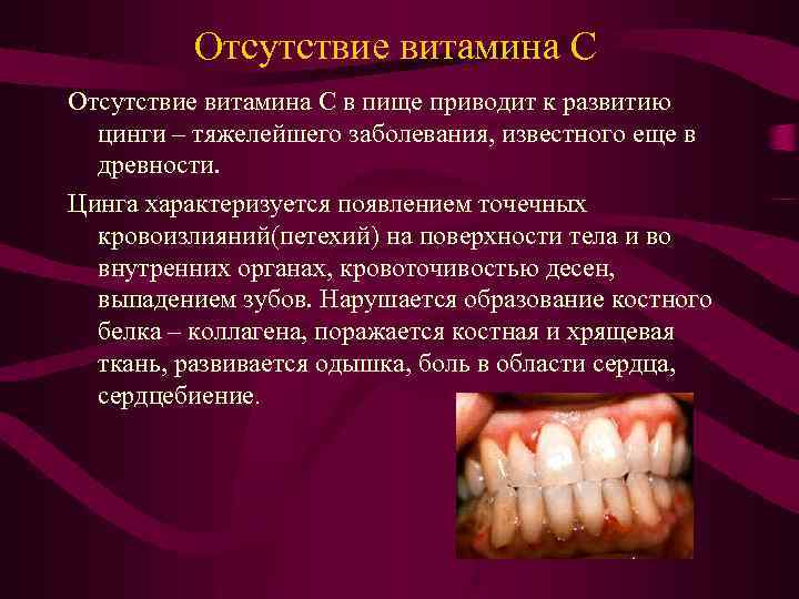 Отсутствие витамина С в пище приводит к развитию цинги – тяжелейшего заболевания, известного еще