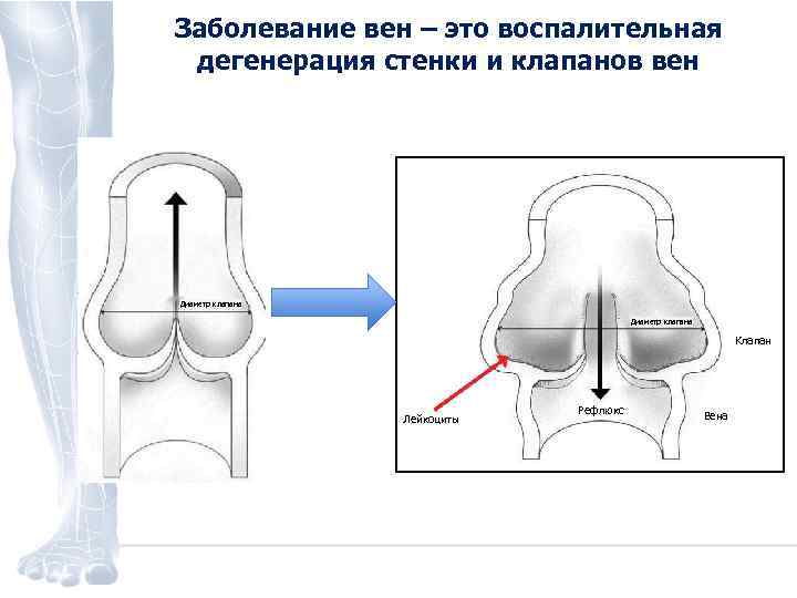 Заболевание вен – это воспалительная дегенерация стенки и клапанов вен Диаметр клапана Клапан Лейкоциты