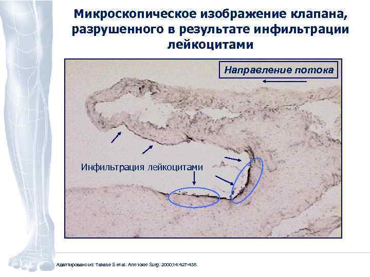 Микроскопическое изображение клапана, разрушенного в результате инфильтрации лейкоцитами Направление потока Инфильтрация лейкоцитами Адаптировано из: