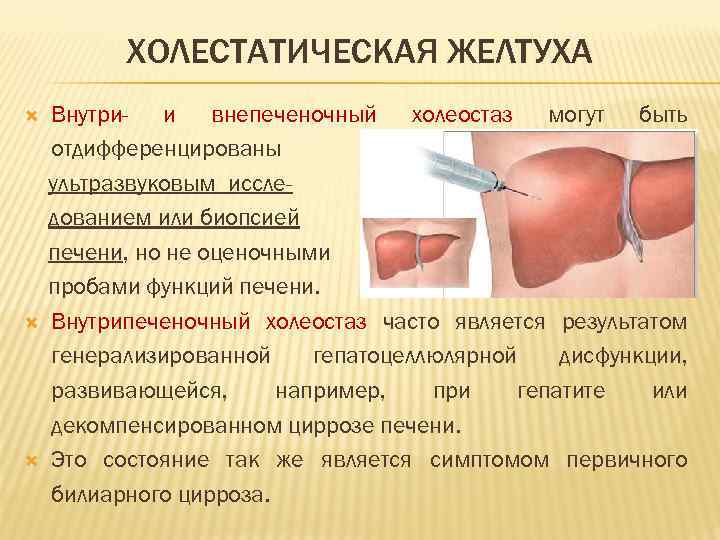 ХОЛЕСТАТИЧЕСКАЯ ЖЕЛТУХА Внутри- и внепеченочный холеостаз могут быть отдифференцированы ультразвуковым исследованием или биопсией печени,