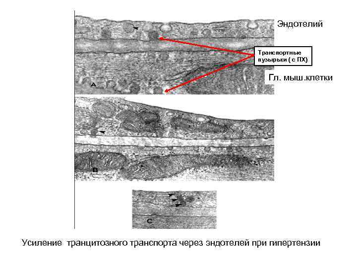 Эндотелий Транспортные пузырьки ( с ПХ) Гл. мыш. клетки Усиление транцитозного транспорта через эндотелей