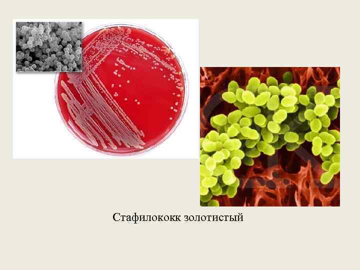 Стафилококк золотистый 