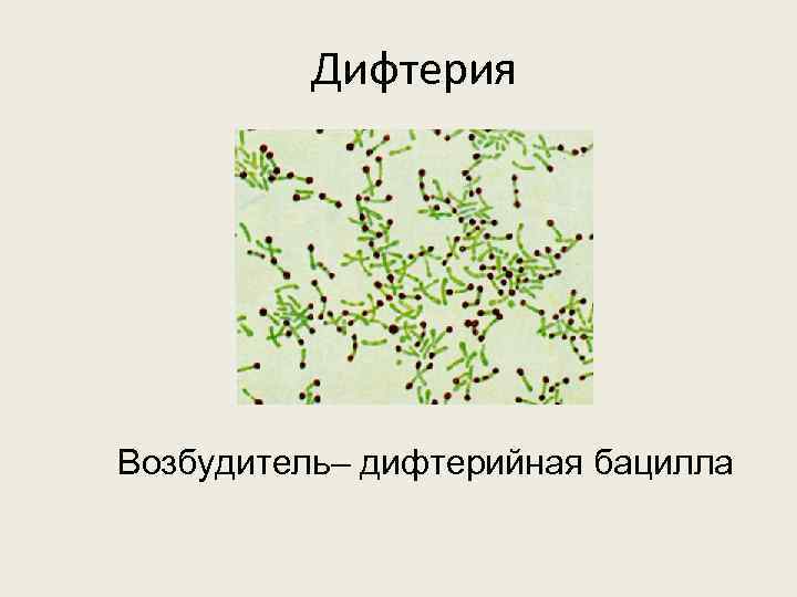 Дифтерия Возбудитель– дифтерийная бацилла 
