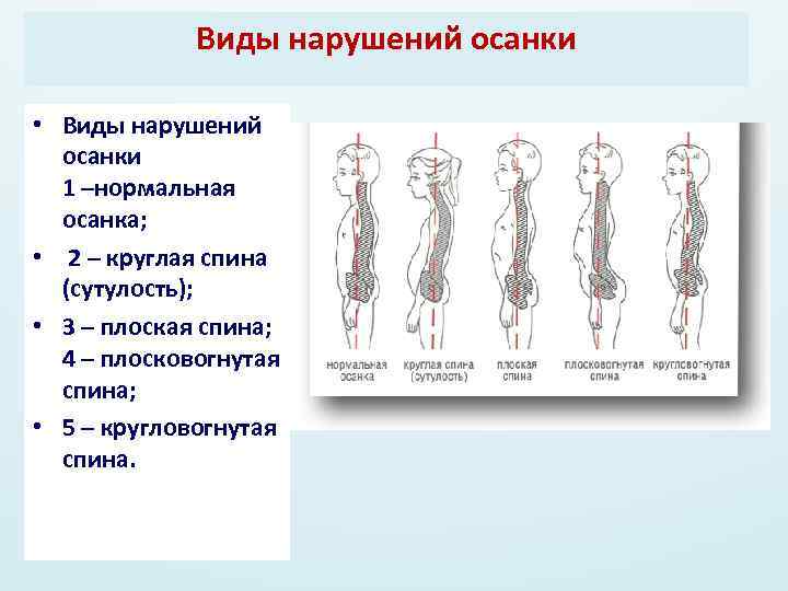 Виды нарушений осанки • Виды нарушений осанки 1 –нормальная осанка; • 2 – круглая