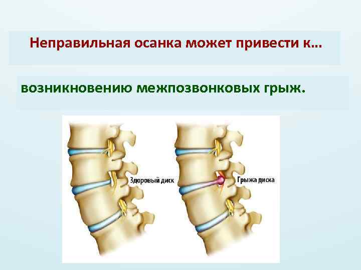  Неправильная осанка может привести к… возникновению межпозвонковых грыж. 
