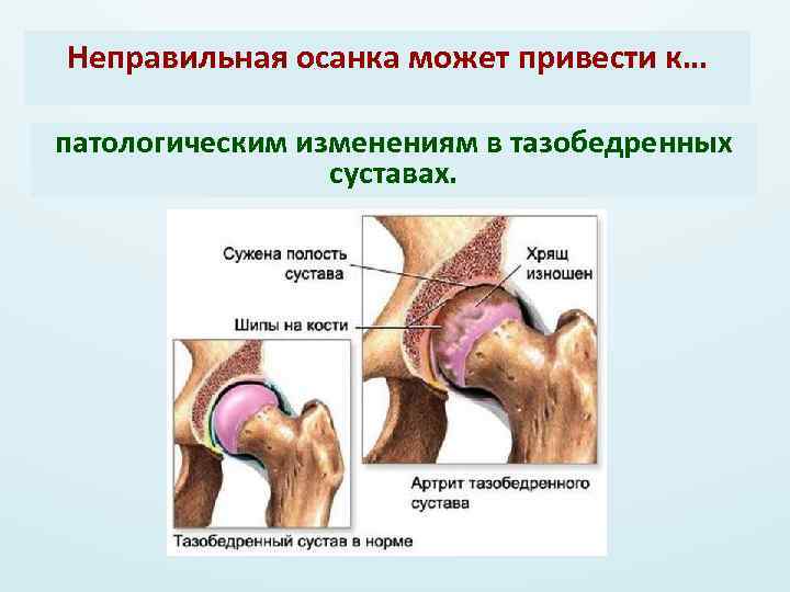 Неправильная осанка может привести к… патологическим изменениям в тазобедренных суставах. 