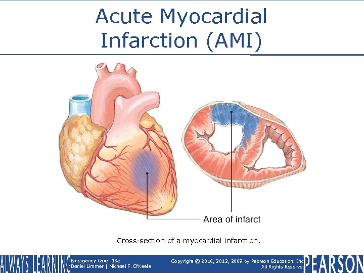 Acute Myocardial Infarction (AMI) Cross-section of a myocardial infarction. Emergency Care, 13 e Daniel