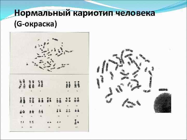 Нормальный кариотип человека (G-окраска) 