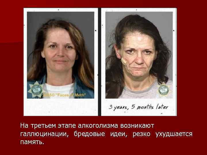 На третьем этапе алкоголизма возникают галлюцинации, бредовые идеи, резко ухудшается память. 