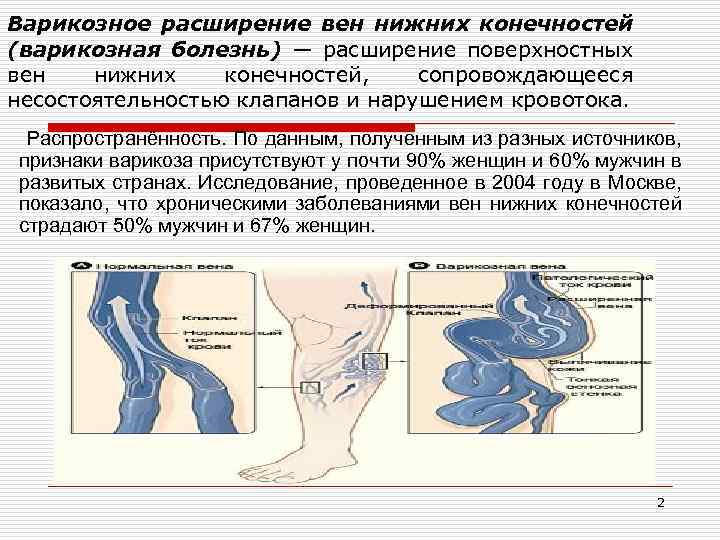 Вены нижних конечностей мкб. Варикозная болезнь распространенность. Расширение поверхностных вен. Недостаточность клапанов вен нижних конечностей. Варикозное расширение вен нижних конечностей код.