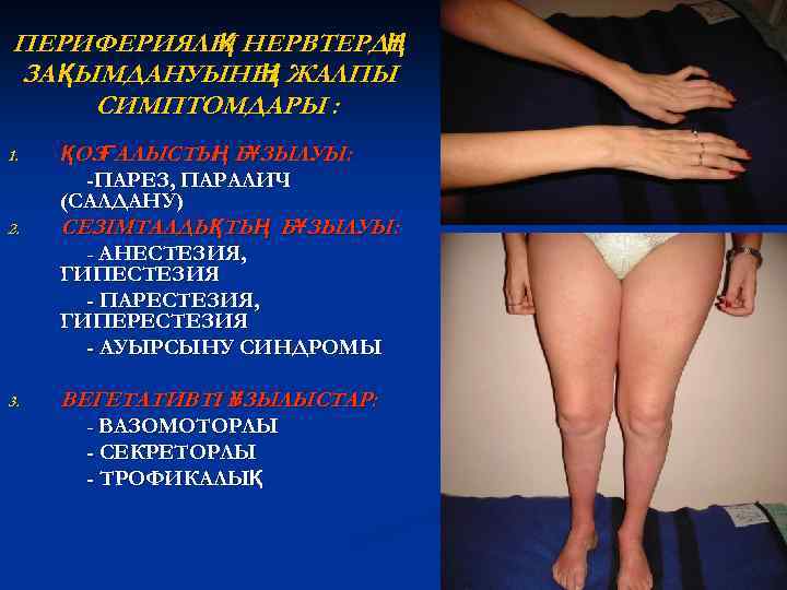ПЕРИФЕРИЯЛЫ НЕРВТЕРДІ Қ Ң ЗА ҚЫМДАНУЫНЫ ЖАЛПЫ Ң СИМПТОМДАРЫ : 1. 2. 3. ҚОЗҒАЛЫСТЫ