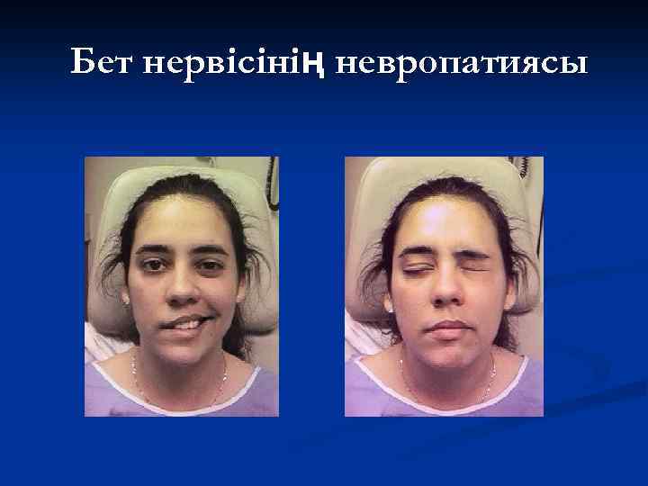 Бет нервісінің невропатиясы 