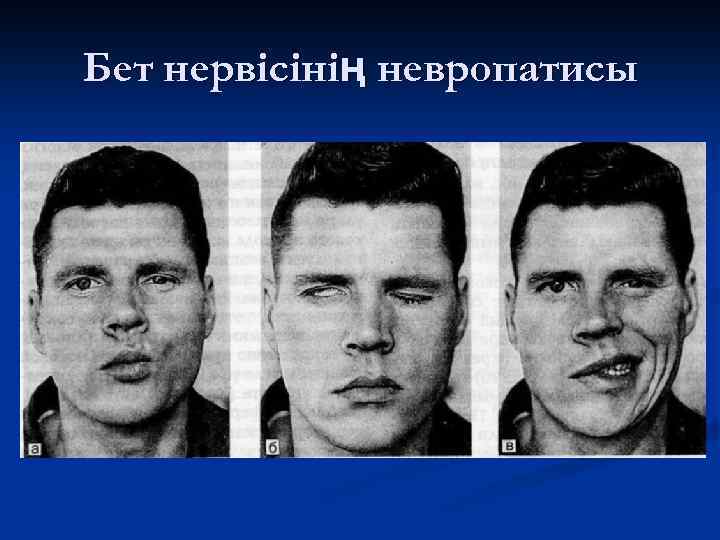 Бет нервісінің невропатисы 