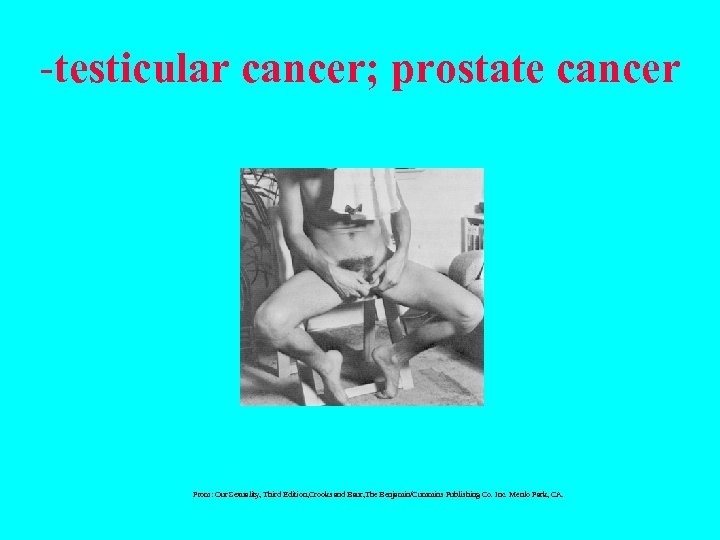 -testicular cancer; prostate cancer From: Our Sexuality, Third Edition, Crooks and Baur, The Benjamin/Cummins