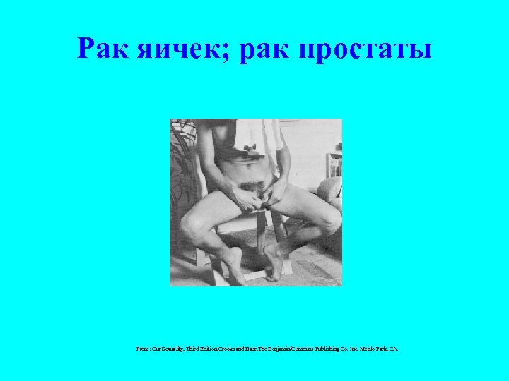 Рак яичек; рак простаты From: Our Sexuality, Third Edition, Crooks and Baur, The Benjamin/Cummins