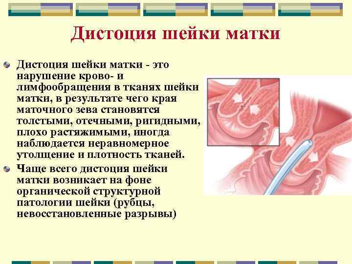Дистоция шейки матки - это нарушение крово- и лимфообращения в тканях шейки матки, в