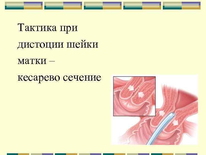 Тактика при дистоции шейки матки – кесарево сечение 
