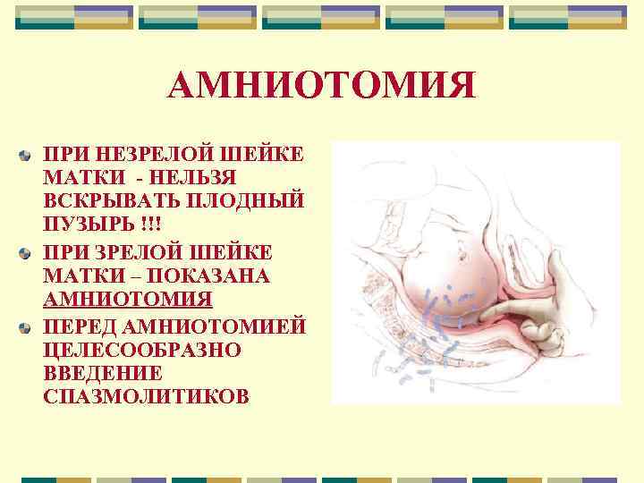 АМНИОТОМИЯ ПРИ НЕЗРЕЛОЙ ШЕЙКЕ МАТКИ - НЕЛЬЗЯ ВСКРЫВАТЬ ПЛОДНЫЙ ПУЗЫРЬ !!! ПРИ ЗРЕЛОЙ ШЕЙКЕ