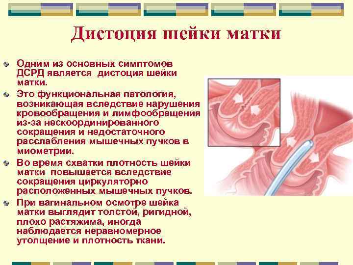 Дистоция шейки матки Одним из основных симптомов ДСРД является дистоция шейки матки. Это функциональная