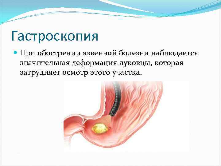 Гастроскопия При обострении язвенной болезни наблюдается значительная деформация луковцы, которая затрудняет осмотр этого участка.