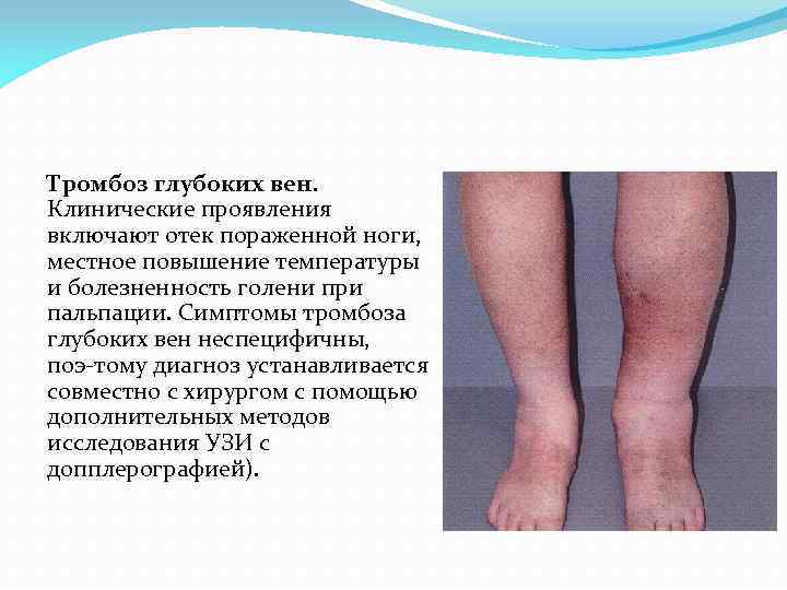 Тромбоз глубоких вен. Клинические проявления включают отек пораженной ноги, местное повышение температуры и болезненность