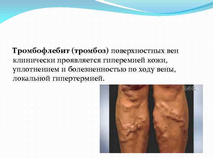 Тромбофлебит (тромбоз) поверхностных вен клинически проявляется гиперемией кожи, уплотнением и болезненностью по ходу вены,