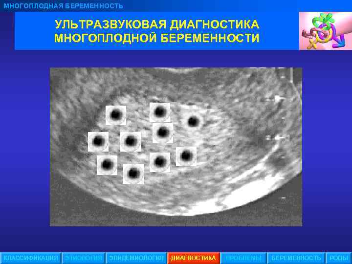 МНОГОПЛОДНАЯ БЕРЕМЕННОСТЬ УЛЬТРАЗВУКОВАЯ ДИАГНОСТИКА МНОГОПЛОДНОЙ БЕРЕМЕННОСТИ КЛАССИФИКАЦИЯ ЭТИОЛОГИЯ ЭПИДЕМИОЛОГИЯ ДИАГНОСТИКА ПРОБЛЕМЫ БЕРЕМЕННОСТЬ РОДЫ 