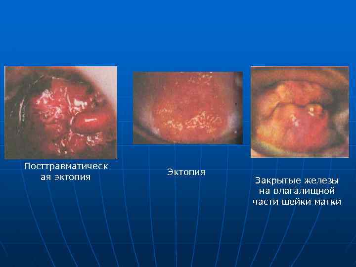 Посттравматическ ая эктопия Эктопия Закрытые железы на влагалищной части шейки матки 