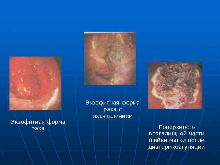Экзофитная форма рака с изъязвлением Поверхность влагалищной части шейки матки после диатермкоагуляции 