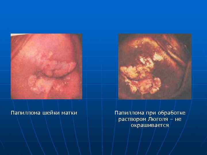 Папиллома шейки матки Папиллома при обработке раствором Люголя – не окрашивается 