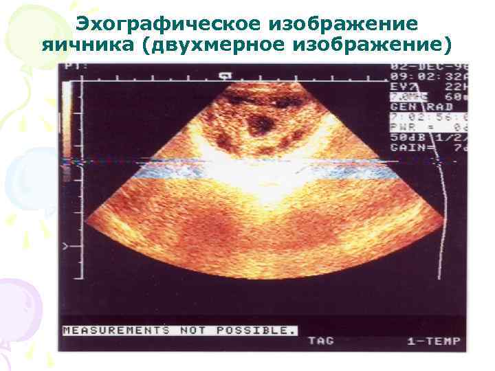 Эхографическое изображение яичника (двухмерное изображение) 