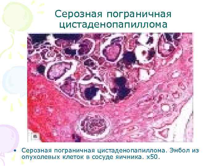 Серозная пограничная цистаденопапиллома • Серозная пограничная цистаденопапиллома. Эмбол из опухолевых клеток в сосуде яичника.