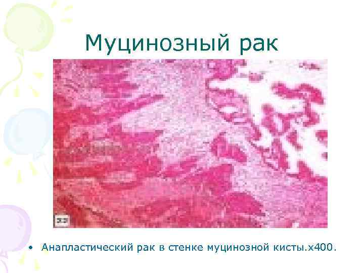 Муцинозный рак