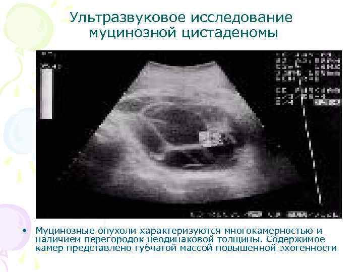 Ультразвуковое исследование муцинозной цистаденомы • Муцинозные опухоли характеризуются многокамерностью и наличием перегородок неодинаковой толщины.