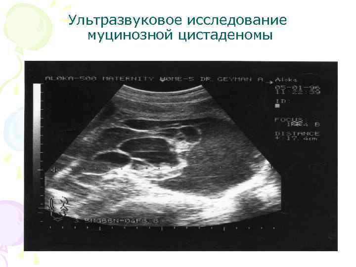 Ультразвуковое исследование муцинозной цистаденомы 