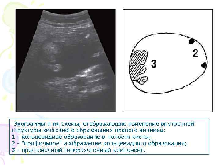 Гиперэхогенное яичник. УЗИ мультифолликулярных яичников. Киста яичника с пристеночным компонентом. Пристеночный компонент на УЗИ. Гиперэхогенные структуры на УЗИ.